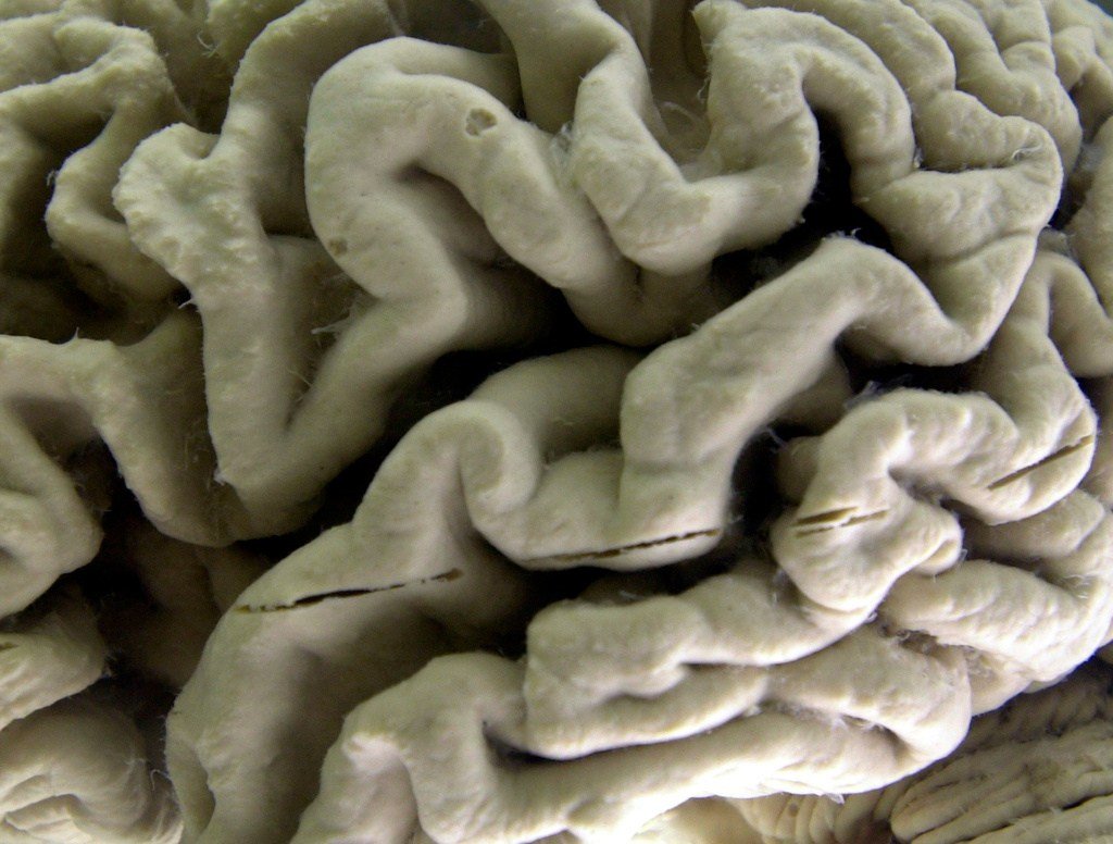 Bipartisan Bill Seeks Medicare Coverage for Alzheimer's Blood Tests