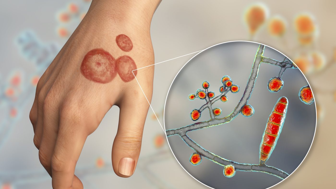 CDC: Drug-Resistant Ringworm Fungus Triples in Cases Across 29 Nations