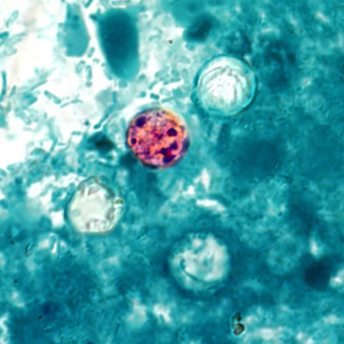 FDA opens fifth cyclospora probe as lettuce-linked cases spread