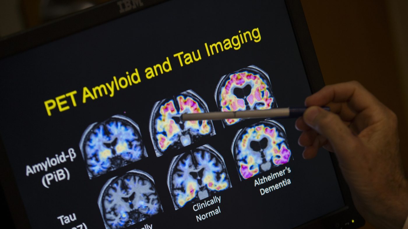 Natural Peptide Catestatin Shows Promise in Alzheimer's Mouse Study