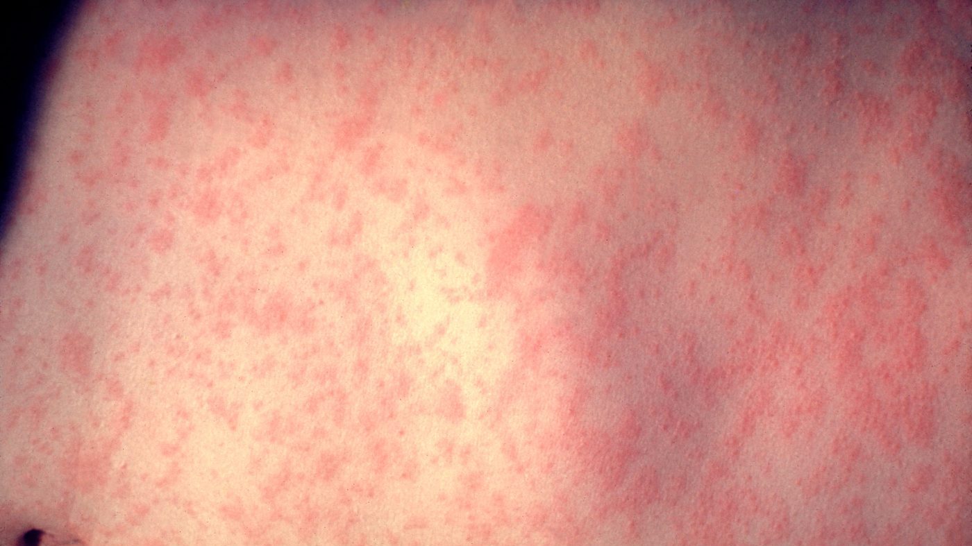 New York Launches Measles Tracker as State Cases Climb to 57