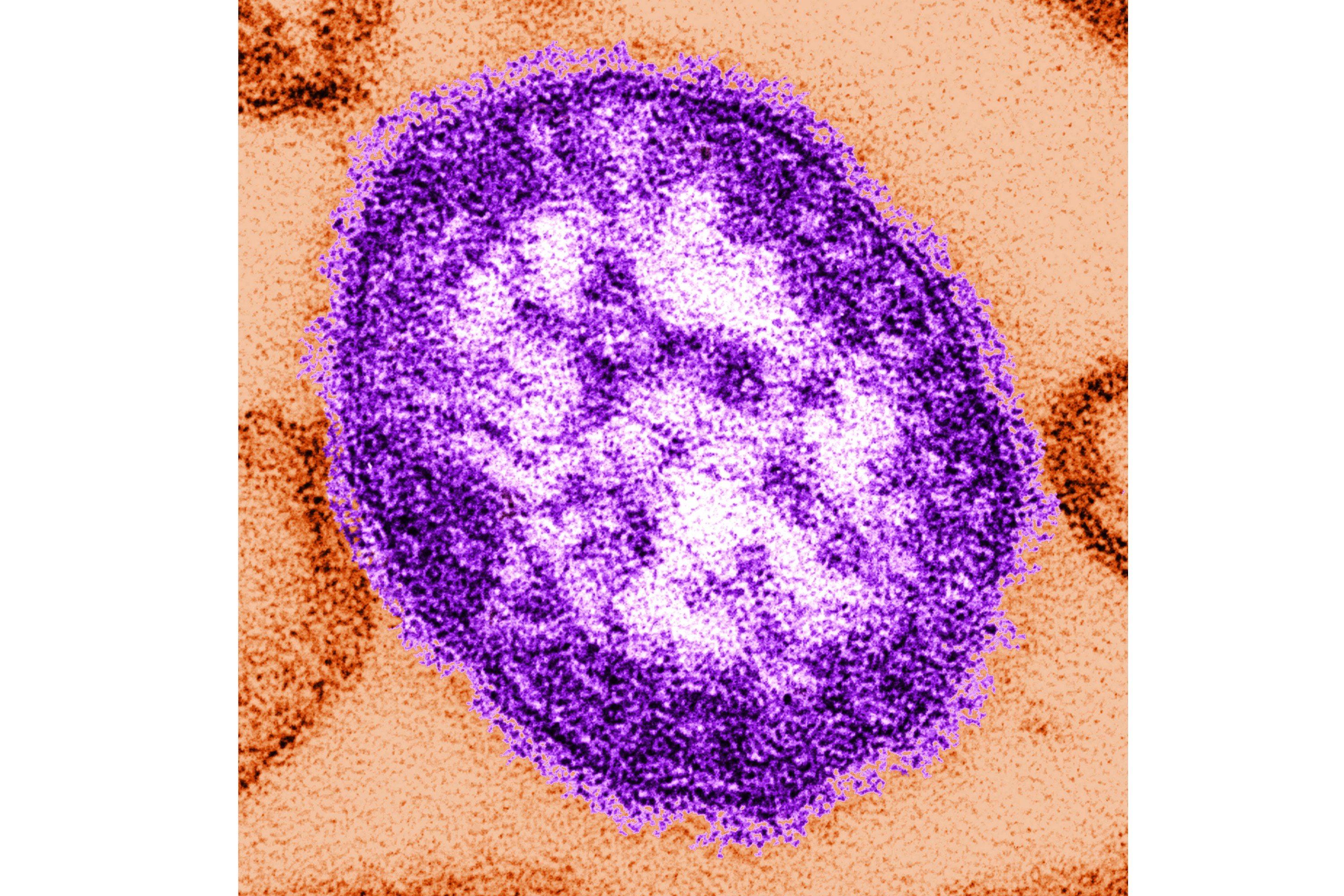 Pennsylvania Confirms Sixth Measles Death as State Leads Nation in Cases